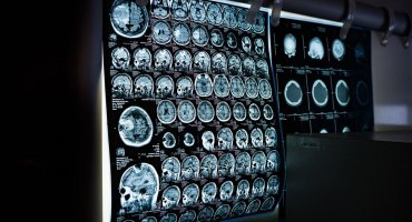 Новый способ диагностировать эпилепсию включает в себя ИИ